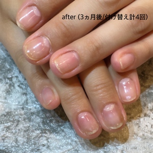 驚異の変身！深爪矯正・爪育成のbefore/after